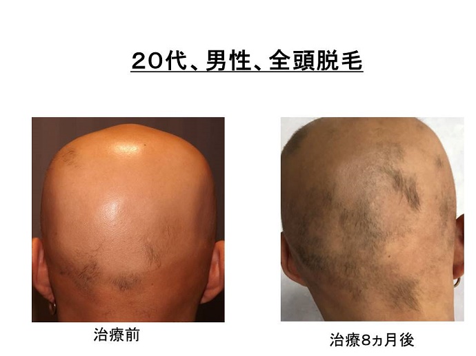 円形脱毛症　病院